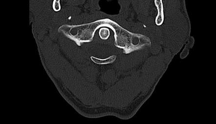 Congenital anomaly of the posterior arch of C1 - Currarino type D ...