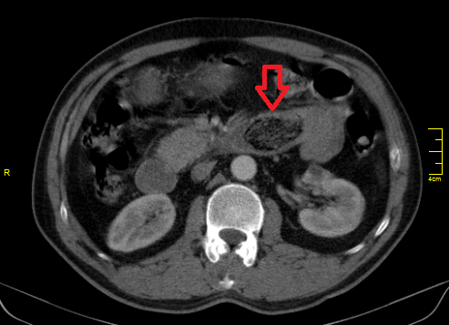 Obstruction due to small bowel bezoar | Image | Radiopaedia.org