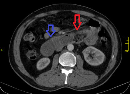 Obstruction due to small bowel bezoar | Image | Radiopaedia.org