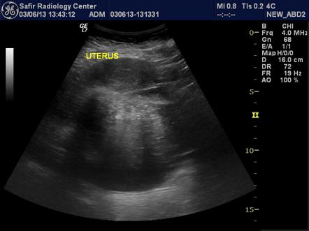 Tip Of The Iceberg Sign Ovarian Dermoid Cyst Radiology