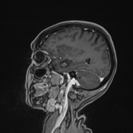 Dysembryoplastic neuroepithelial tumor (DNET) | Image | Radiopaedia.org