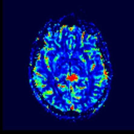 Dysembryoplastic neuroepithelial tumor (DNET) | Image | Radiopaedia.org