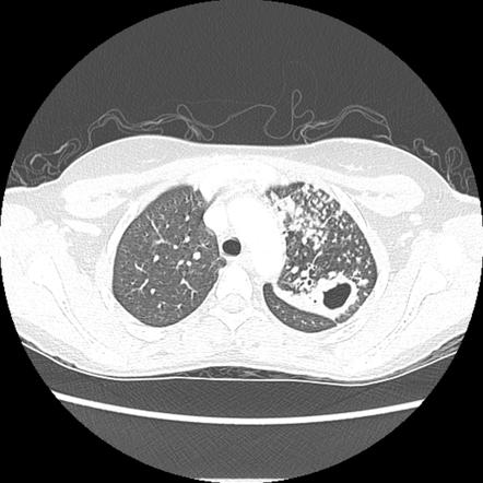 Post-primary pulmonary tuberculosis | Radiology Reference Article ...