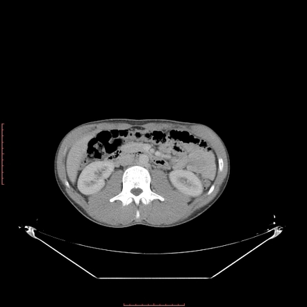 wandering spleen case report