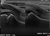 Hutchinson syndrome | Radiology Reference Article | Radiopaedia.org