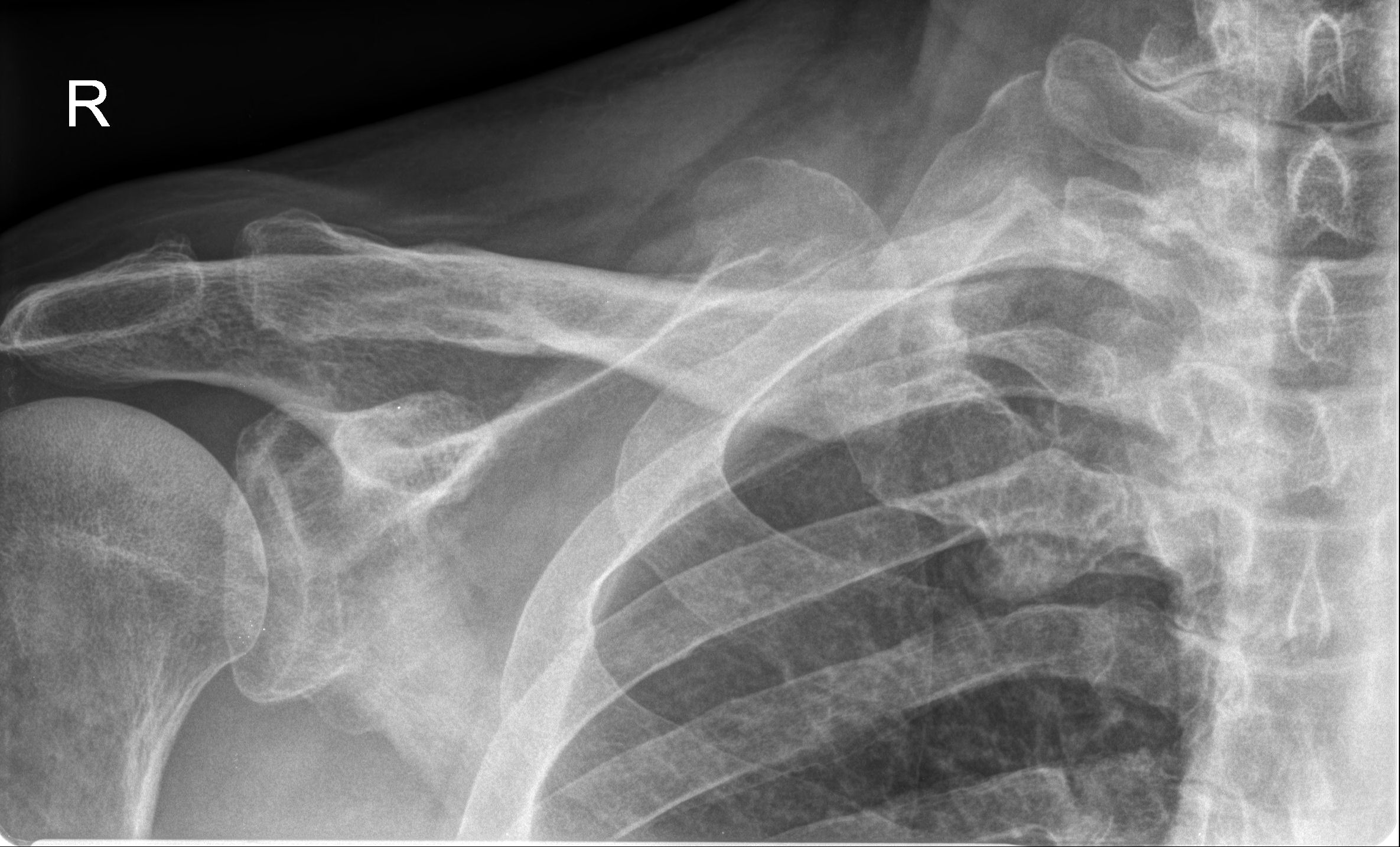 Sternoclavicular Joint Dislocation Image