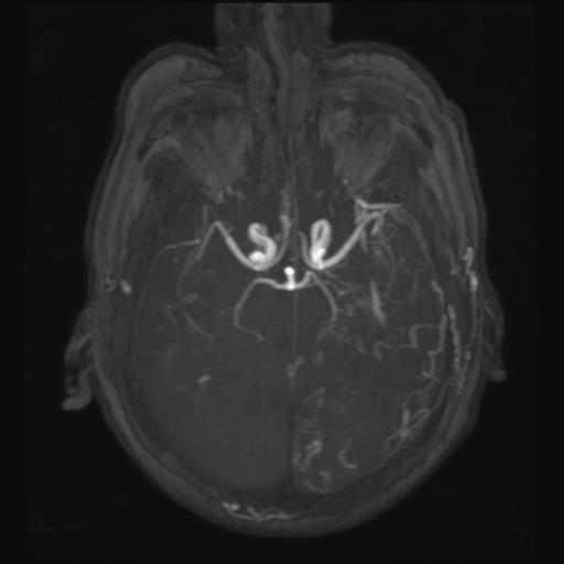 Dural arteriovenous fistula | Image | Radiopaedia.org