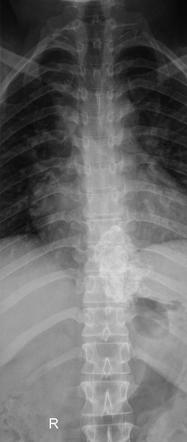 Osteochondroma - spine | Radiology Case | Radiopaedia.org