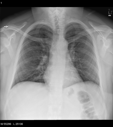 PICC Line X Ray