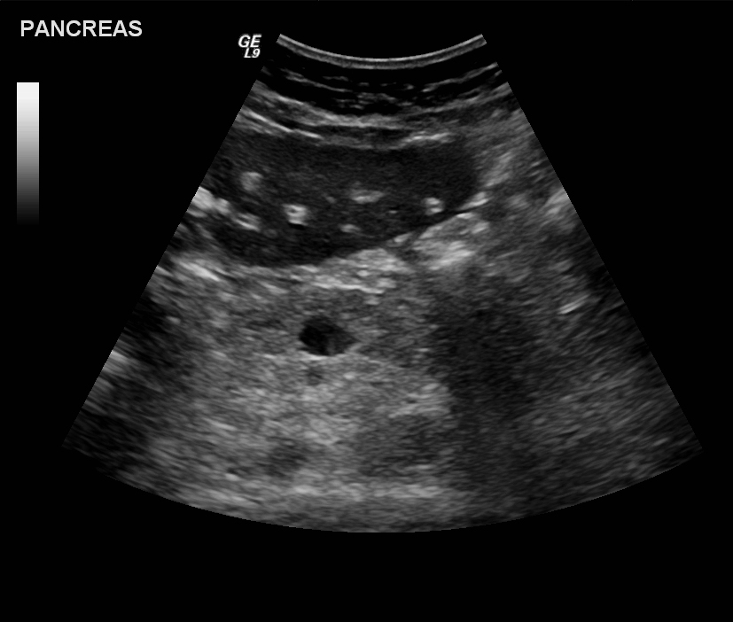 Periportal fibrosis in schistosomiasis | Image | Radiopaedia.org