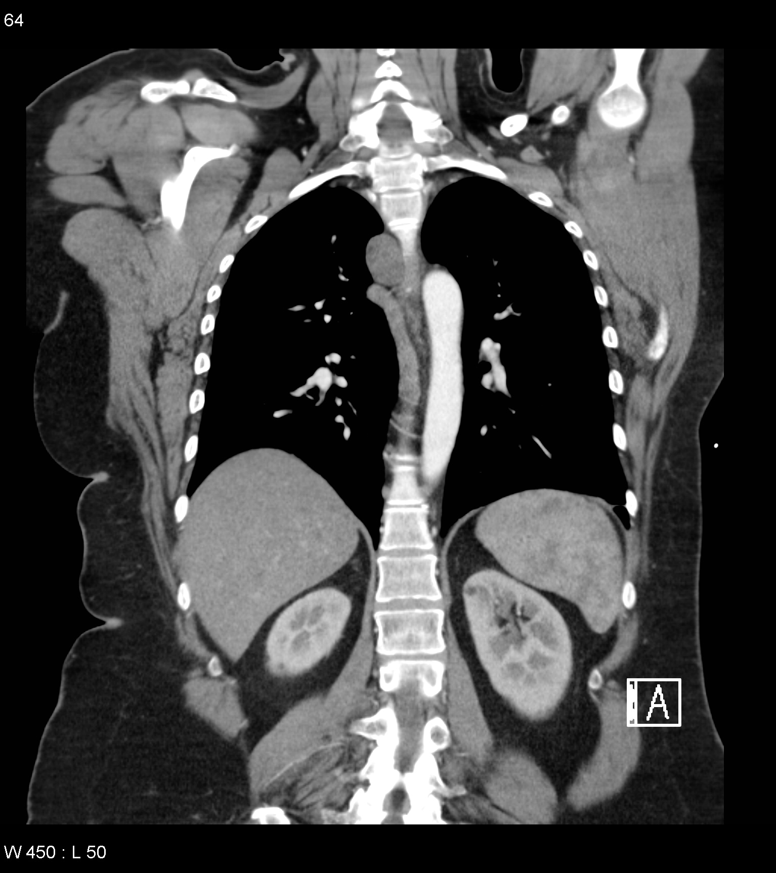 Foregut Duplication Cyst Image