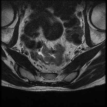 Rectal Cancer (staging) | Radiology Reference Article | Radiopaedia.org