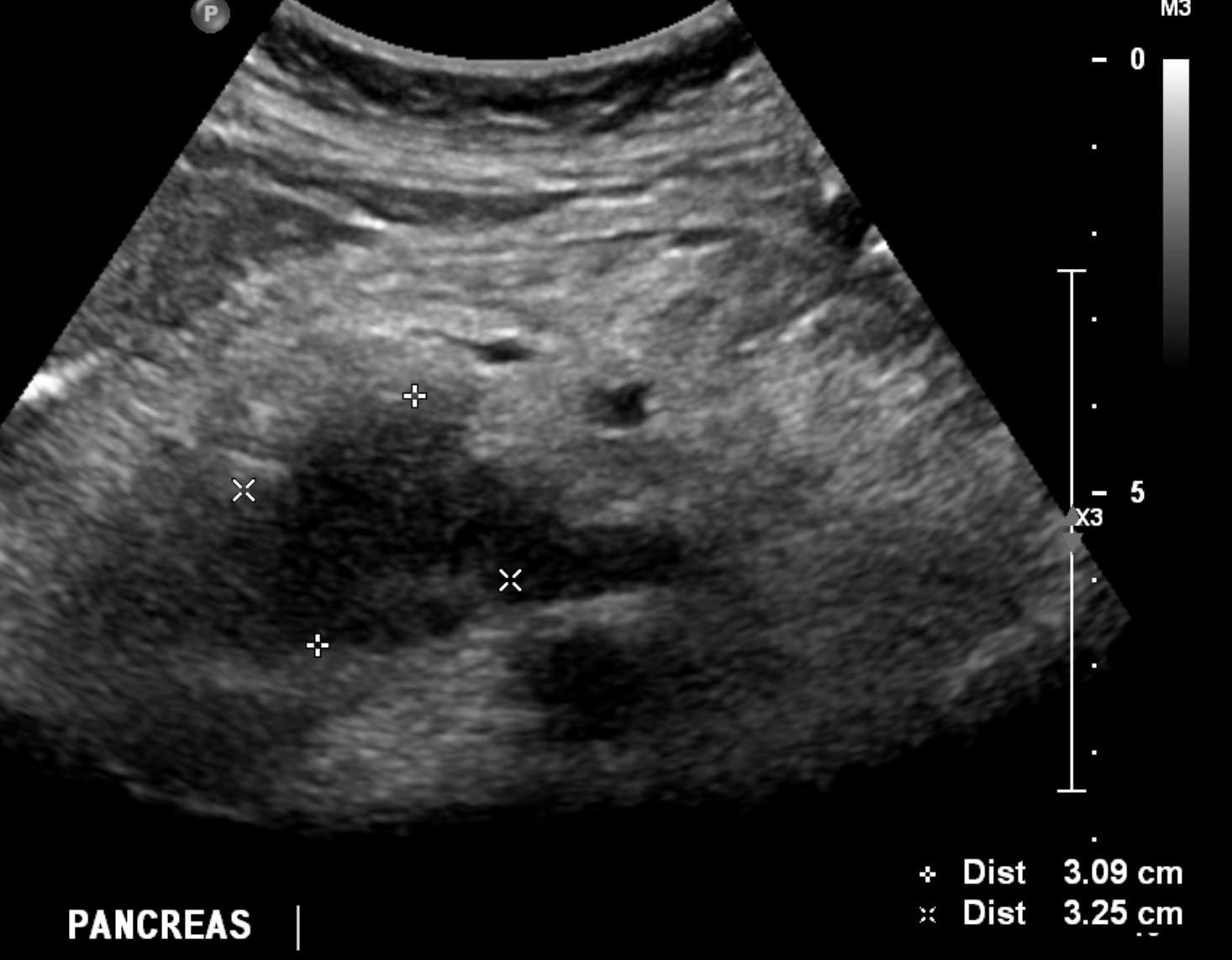 Pancreas adenocarcinoma - uncinate process | Image | Radiopaedia.org