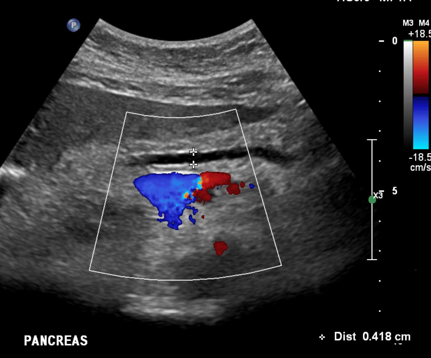 Pancreas Adenocarcinoma - Uncinate Process | Image | Radiopaedia.org