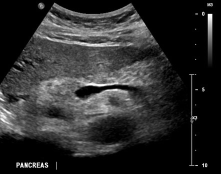 Pancreas adenocarcinoma - uncinate process | Image | Radiopaedia.org