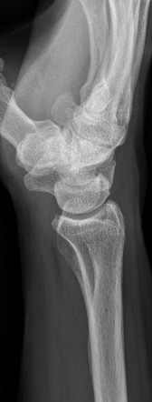 Pisiform fracture | Image | Radiopaedia.org