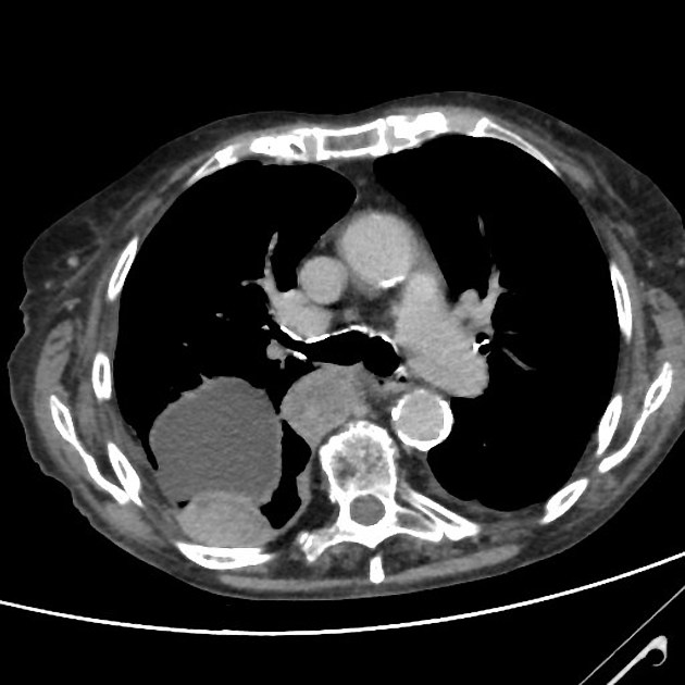 Mesothelioma | Radiology Reference Article | Radiopaedia.org