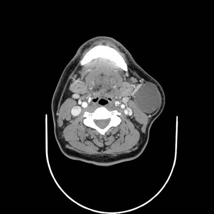 Second branchial cleft cyst | Radiology Case | Radiopaedia.org