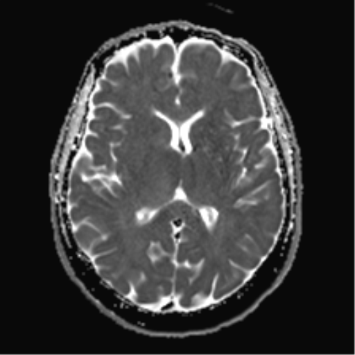 Anaplastic astrocytoma - thalamic glioma | Image | Radiopaedia.org