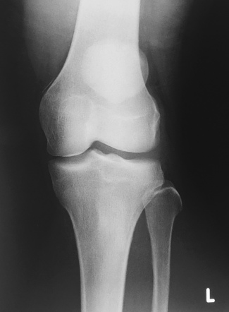 Pellegrini-Stieda lesion | Radiology Reference Article | Radiopaedia.org