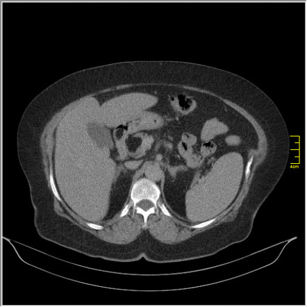 Pancreatic lipoma | Radiology Case | Radiopaedia.org