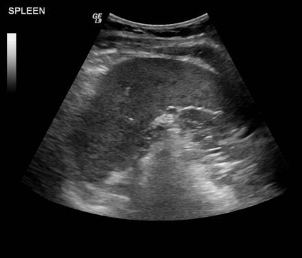 Periportal fibrosis in schistosomiasis | Image | Radiopaedia.org