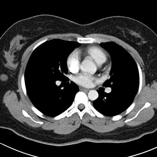 Metastatic thigh liposarcoma | Image | Radiopaedia.org