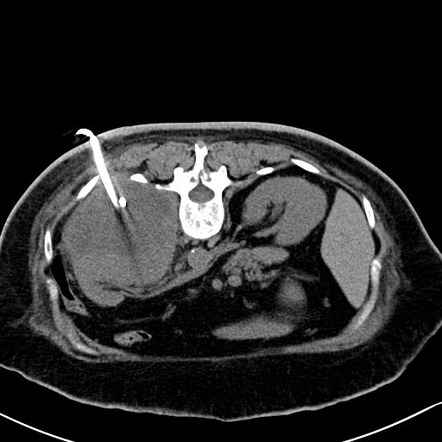 ir drainage of abscess