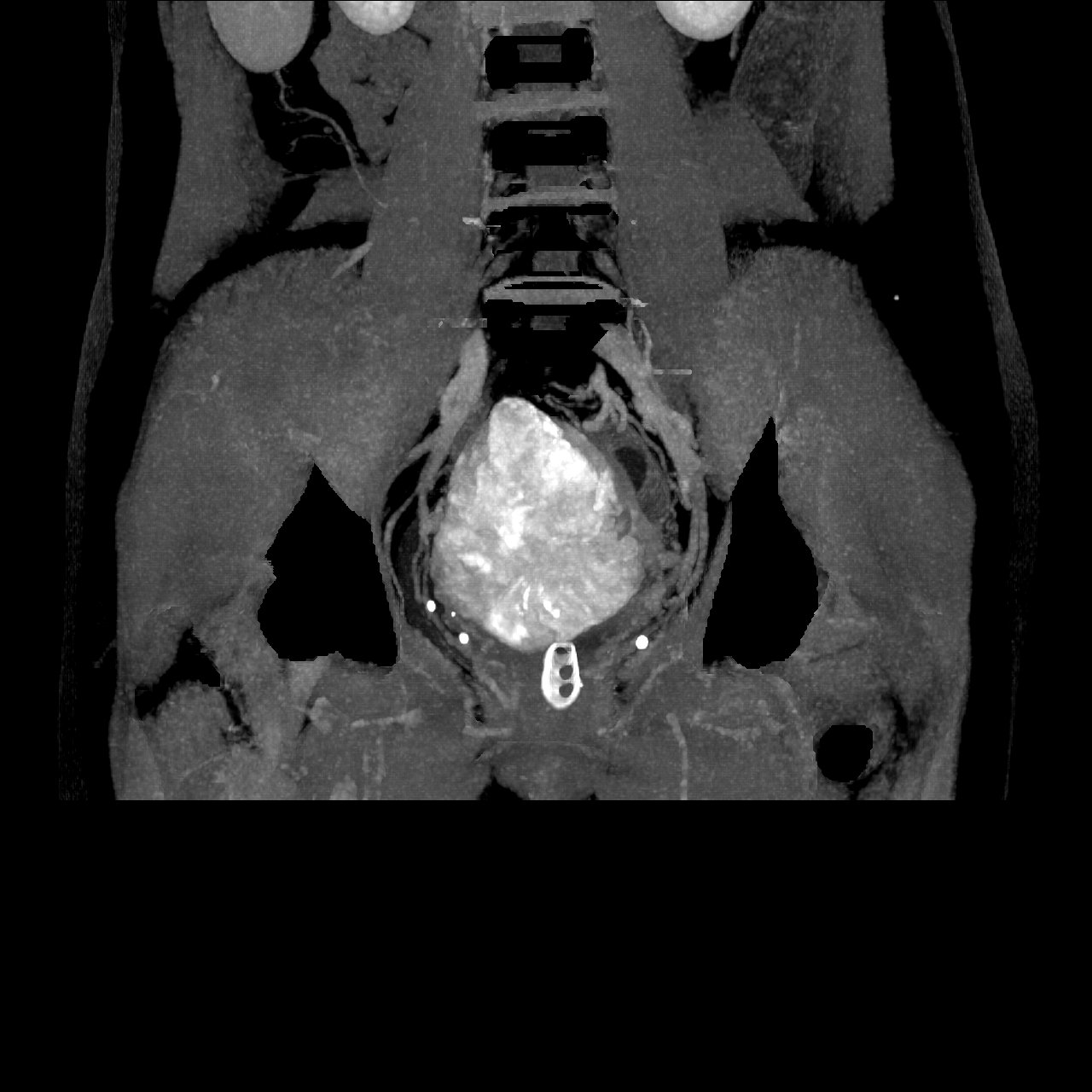 Primary Peritoneal Serous Carcinoma Image