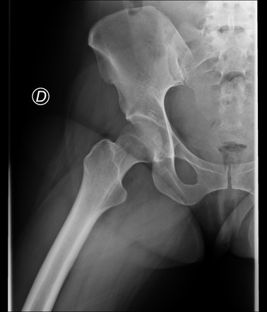 Idiopathic transient osteoporosis of the hip post partum | Image ...