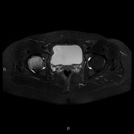 Idiopathic transient osteoporosis of the hip post partum | Image ...