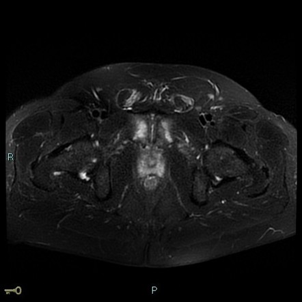 Osteitis pubis (rectal-adductor syndrome) | Radiology Case ...