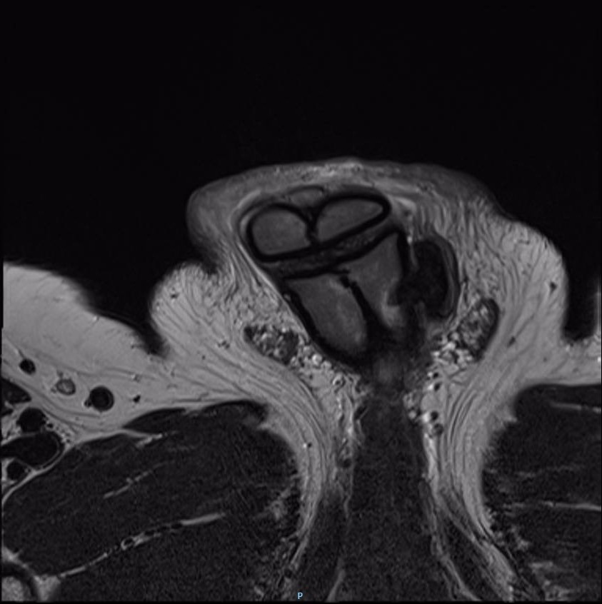 Penile Fracture | Image | Radiopaedia.org