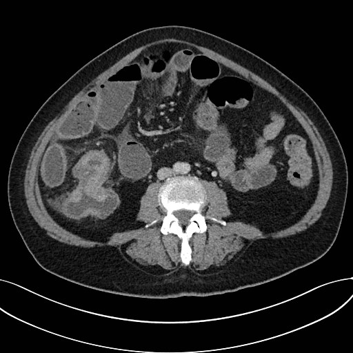 Small bowel obstruction secondary to cecal mass | Image | Radiopaedia.org