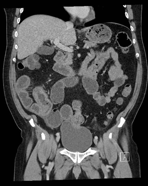 Small bowel obstruction secondary to cecal mass | Image | Radiopaedia.org