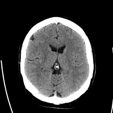 Adamantinomatous craniopharyngioma | Image | Radiopaedia.org