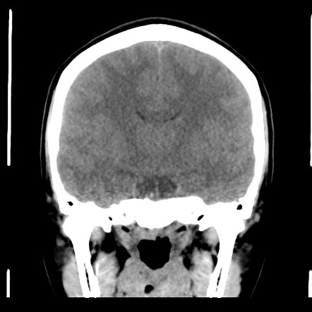 Rathke's cleft cyst | Radiology Case | Radiopaedia.org