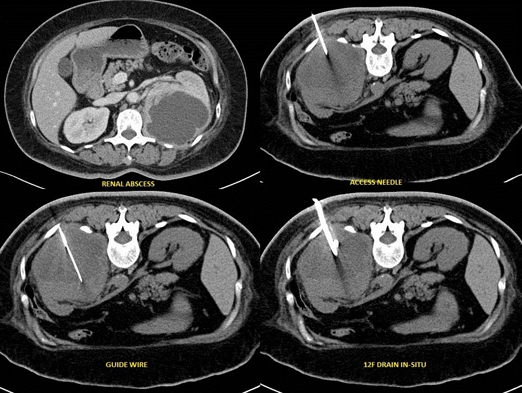 ir drainage of abscess