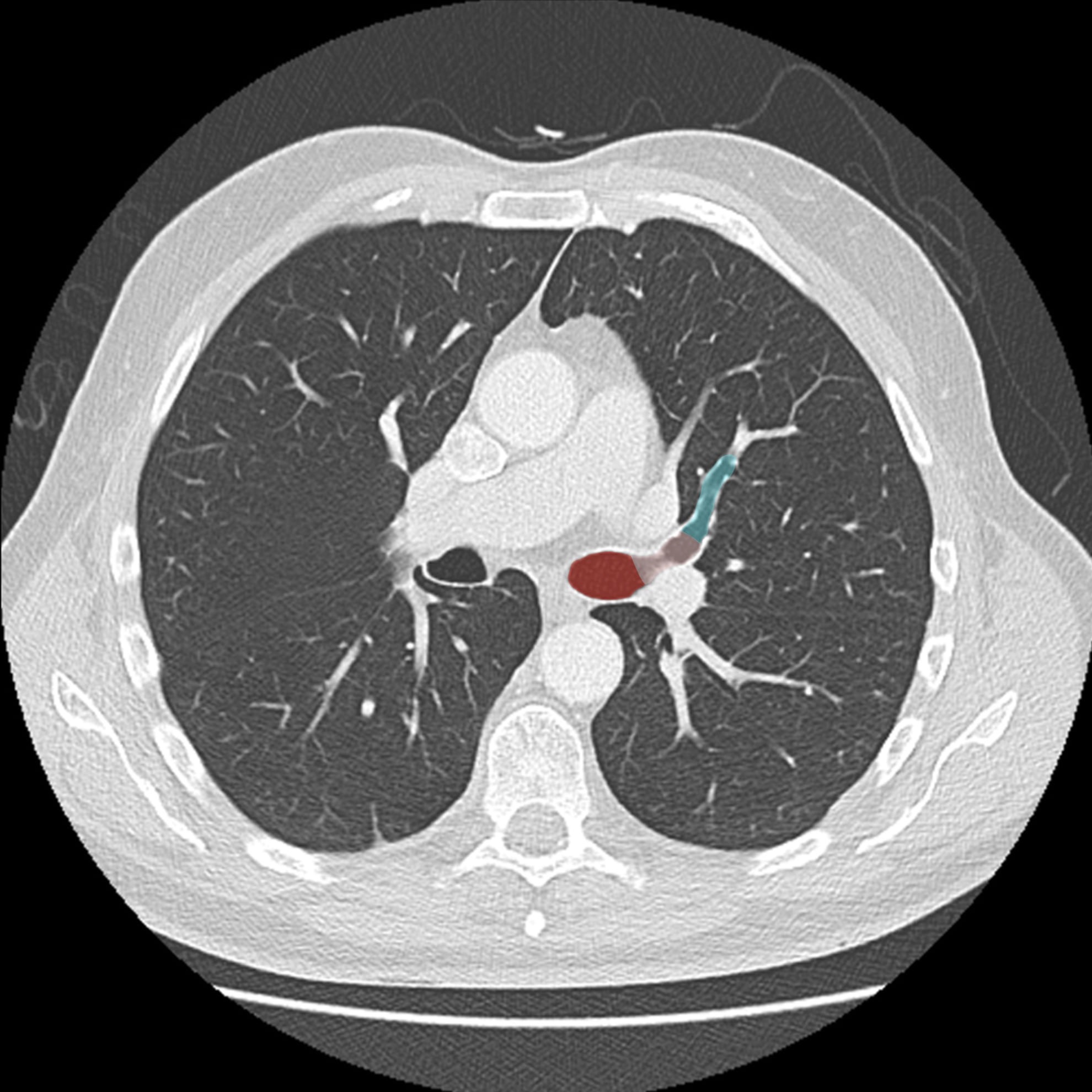 Modality: Annotated image (CT lung window) .