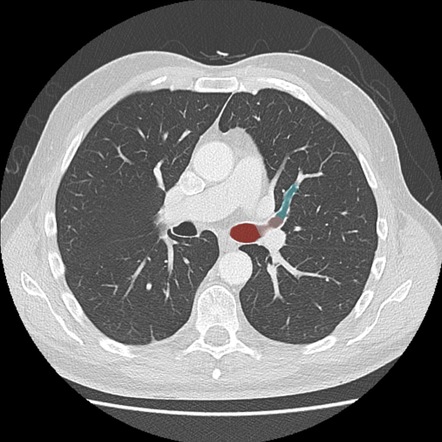 Left upper lobe inferior lingular segment | Radiology Reference Article ...