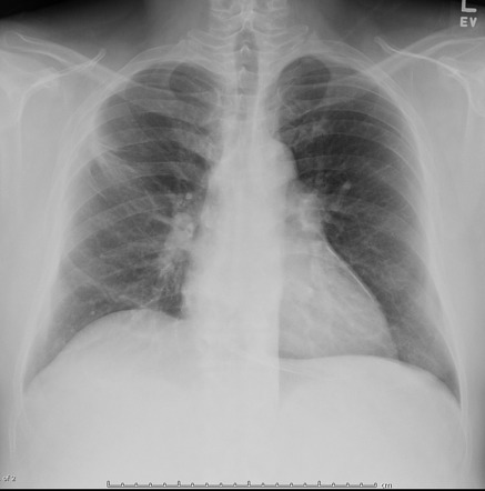 Tuberculous pericardial calcifications | Radiology Case | Radiopaedia.org