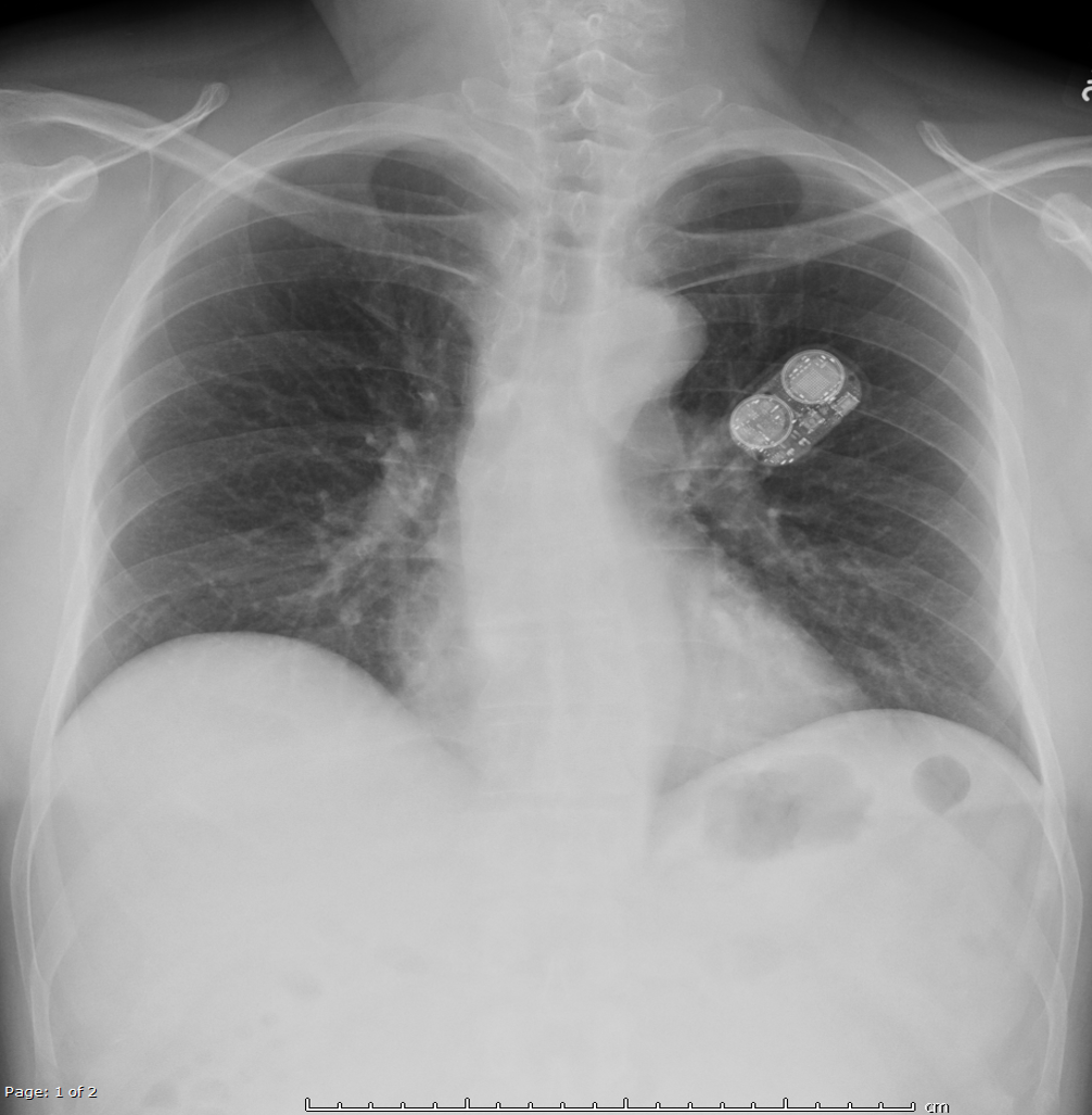 Ambulatory cardiac monitor (ZIO XT patch) on chest xray Image