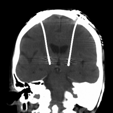 Deep brain stimulation | Radiology Reference Article | Radiopaedia.org