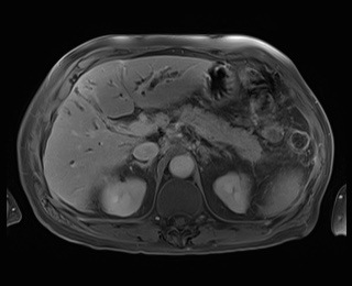 Cholangiocarcinoma - hilar type | Image | Radiopaedia.org