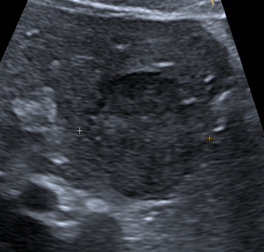 Liver Masses Ultrasound