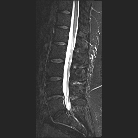 Foraminal Lumbar Disc Protrusion Image Radiopaedia Org