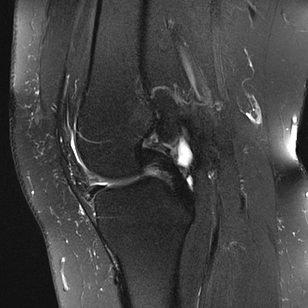 Chondromalacia patellae - grade IV | Image | Radiopaedia.org