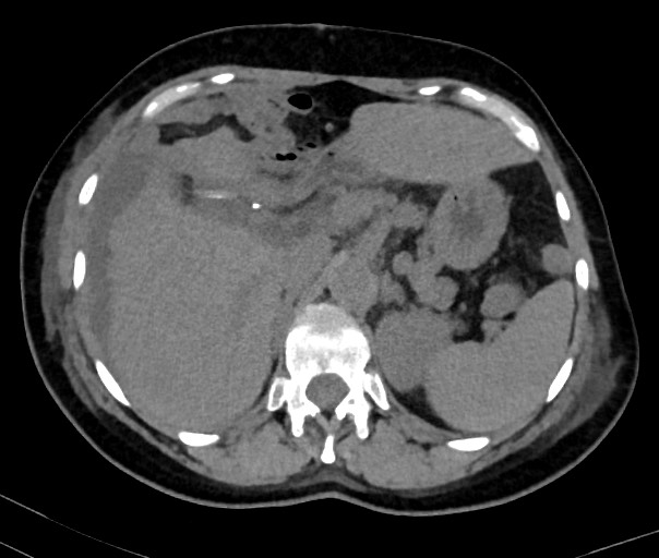 Post cholecystectomy bile leak | Image | Radiopaedia.org