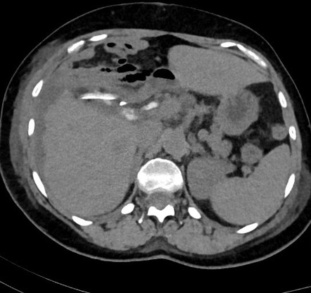 Post cholecystectomy bile leak | Radiology Case | Radiopaedia.org