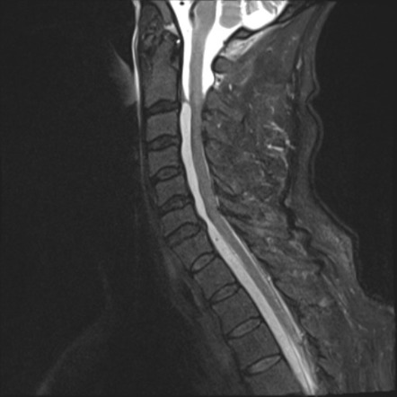 Epidural abscess | Radiology Case | Radiopaedia.org